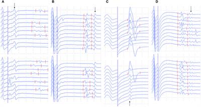 A Retrospective Study of the Characteristics and Clinical Significance of A-Waves in Amyotrophic Lateral Sclerosis